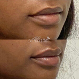 Lip Filler at Allure Aesthetics