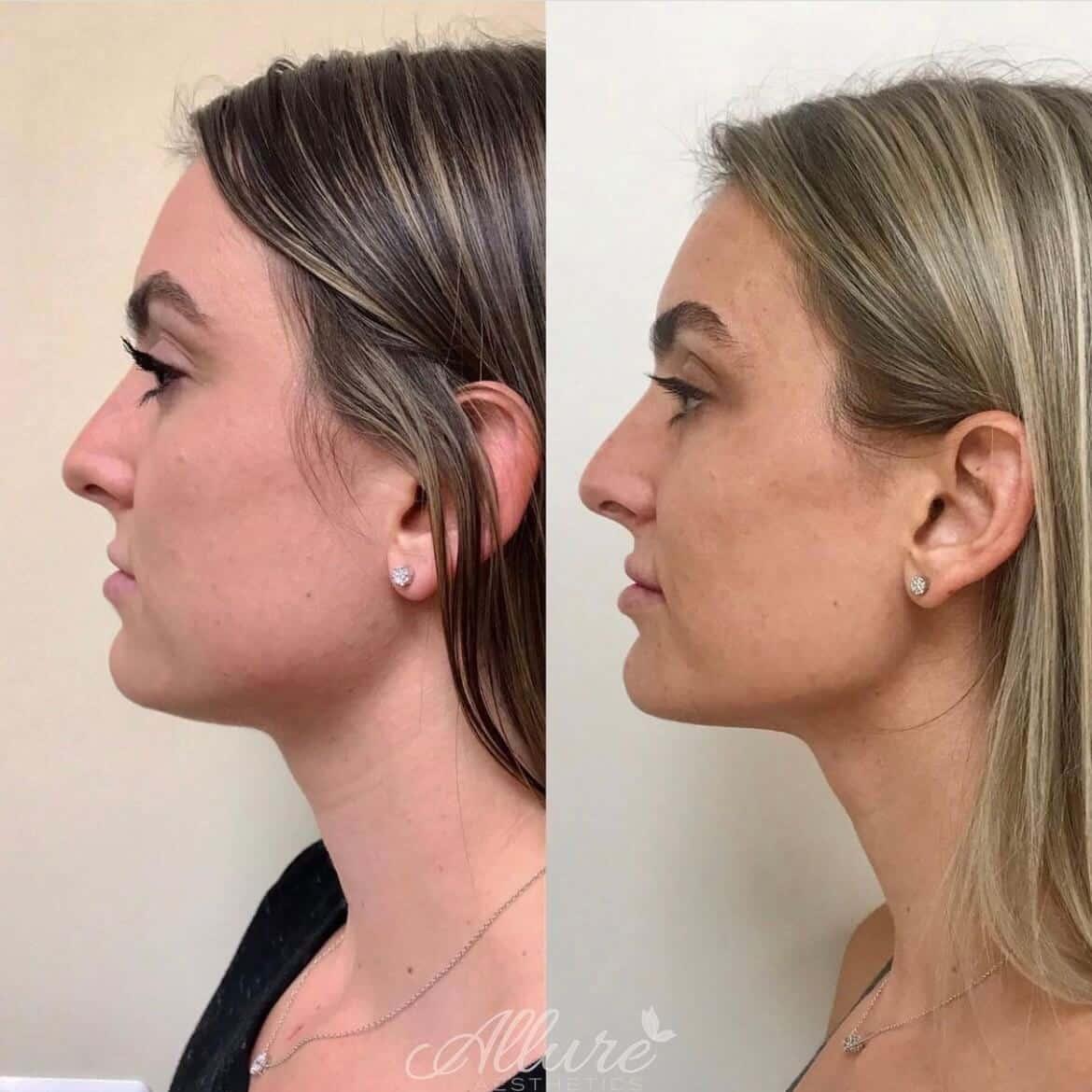 Before-and-after showing reduced submental fullness and enhanced jawline contour which included Kybella treatment at Allure Aesthetics