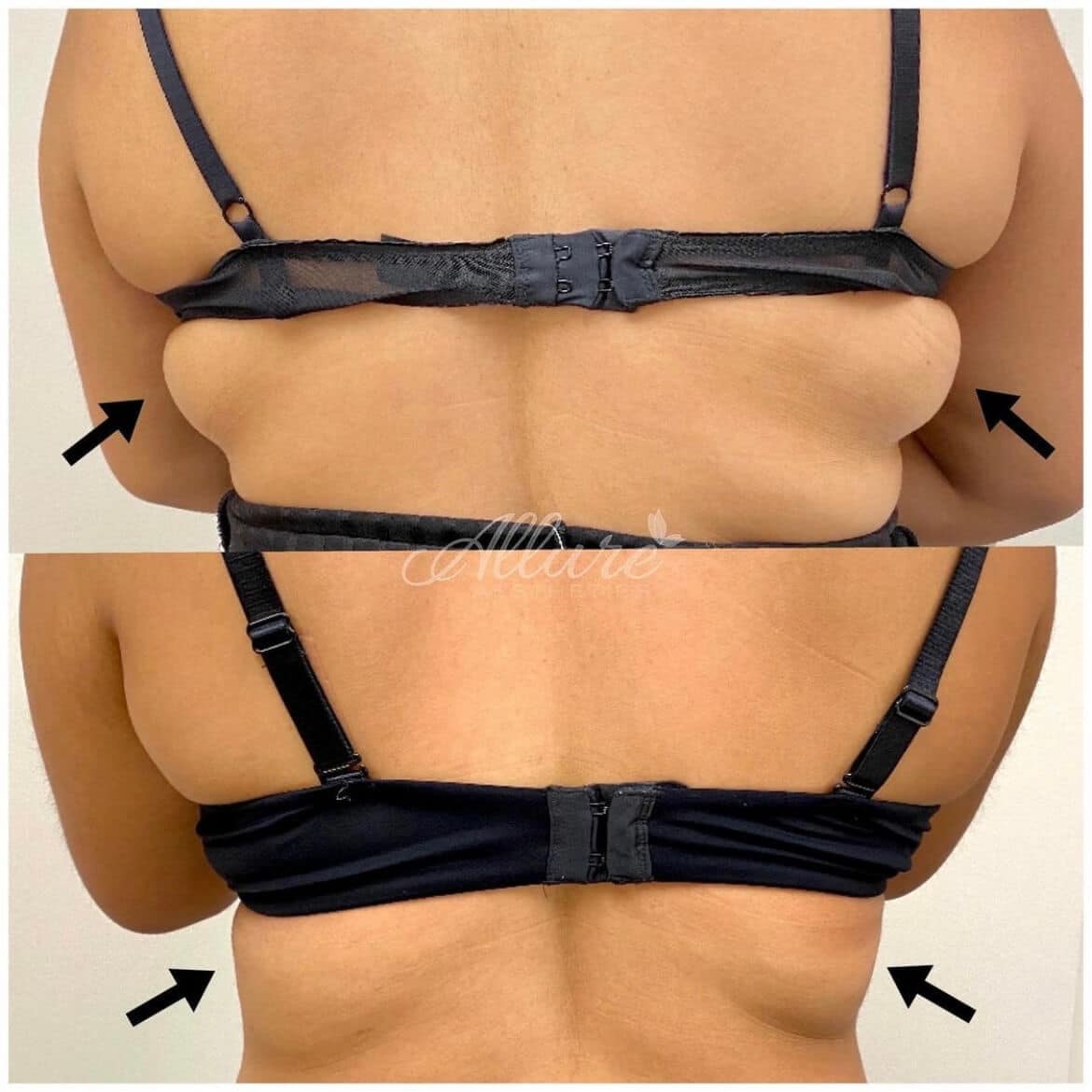 Before-and-after showing reduction of bra line bulge following off-label Kybella treatment at Allure Aesthetics
