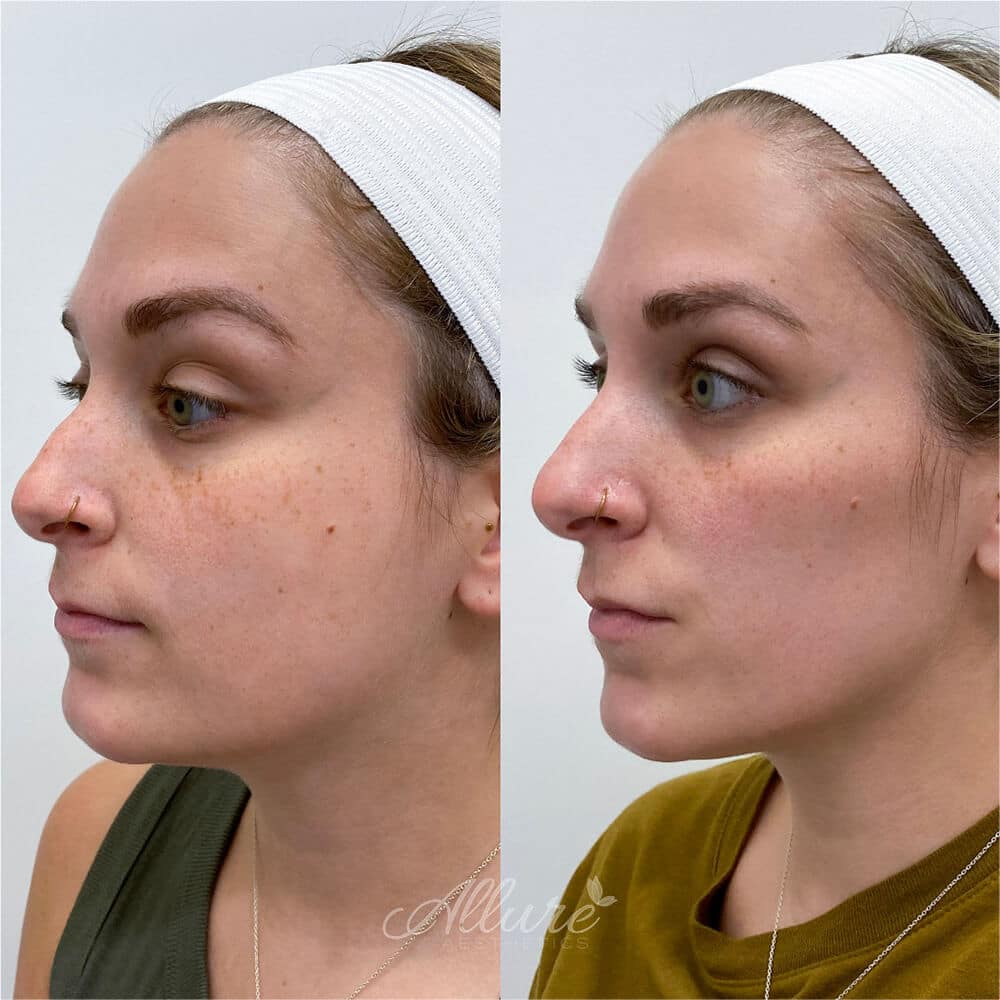 Before-and-after showing defined lower face and submental region after jawline contouring, including Kybella at Allure Aesthetics