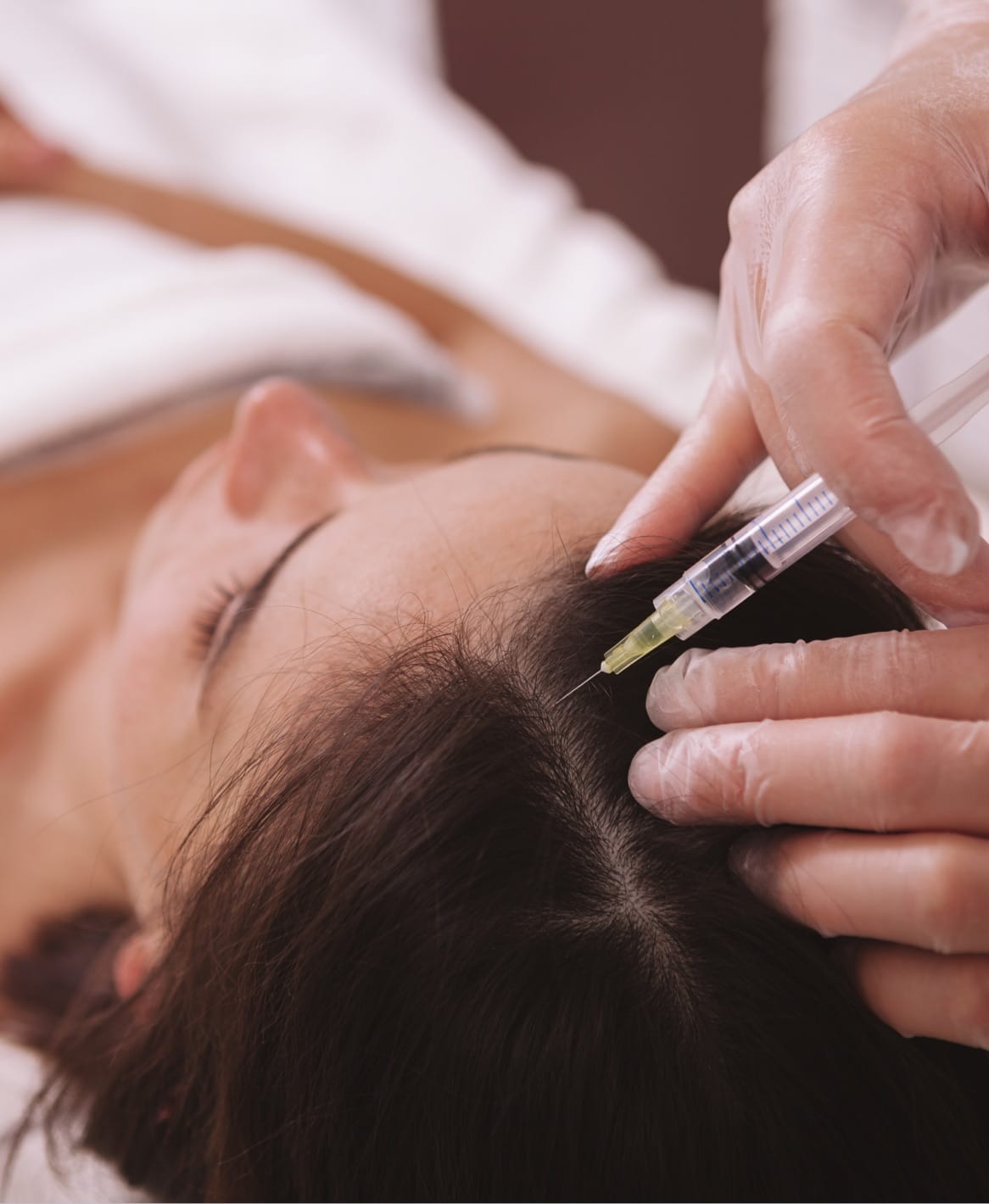 Example of platelet-rich fibrin (PRFM) application near the hairline