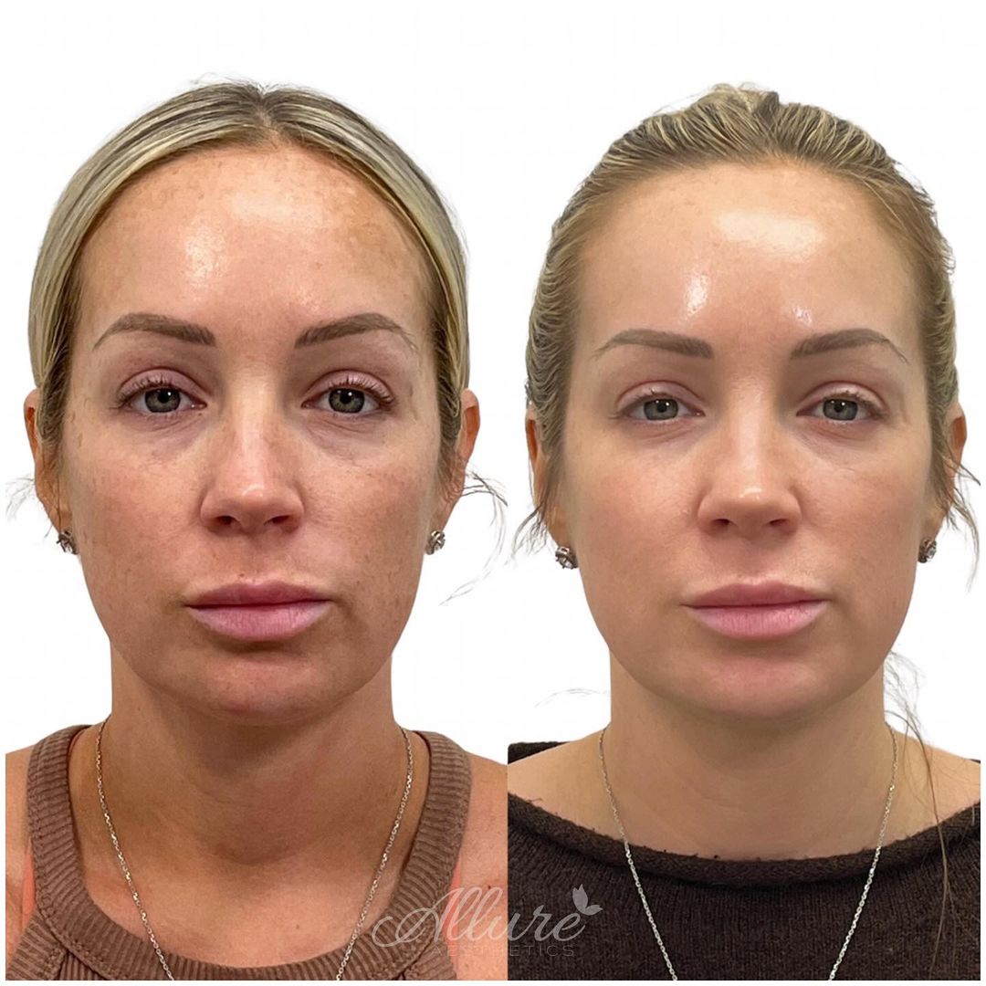 Before and after results of a Moxi Laser treatment at Allure Aesthetics, showing significant reduction in sun damage and hyperpigmentation.