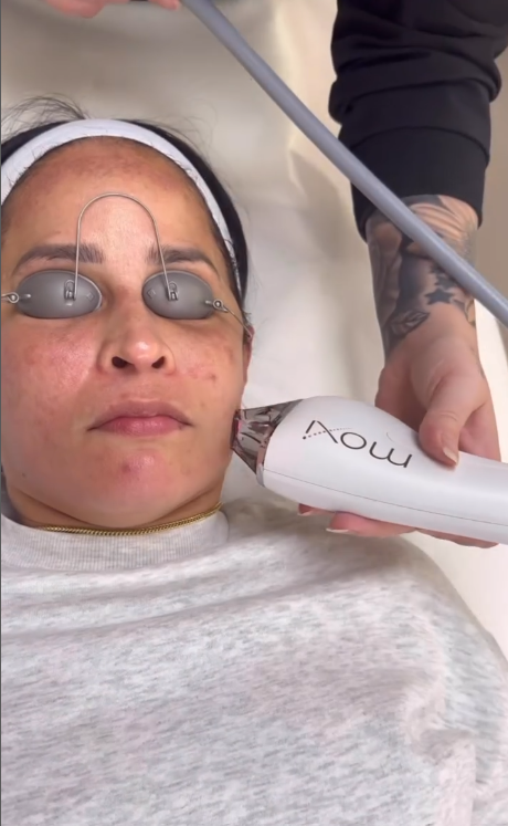 Woman receiving moxi laser treatment on the face at Allure Aesthetics.