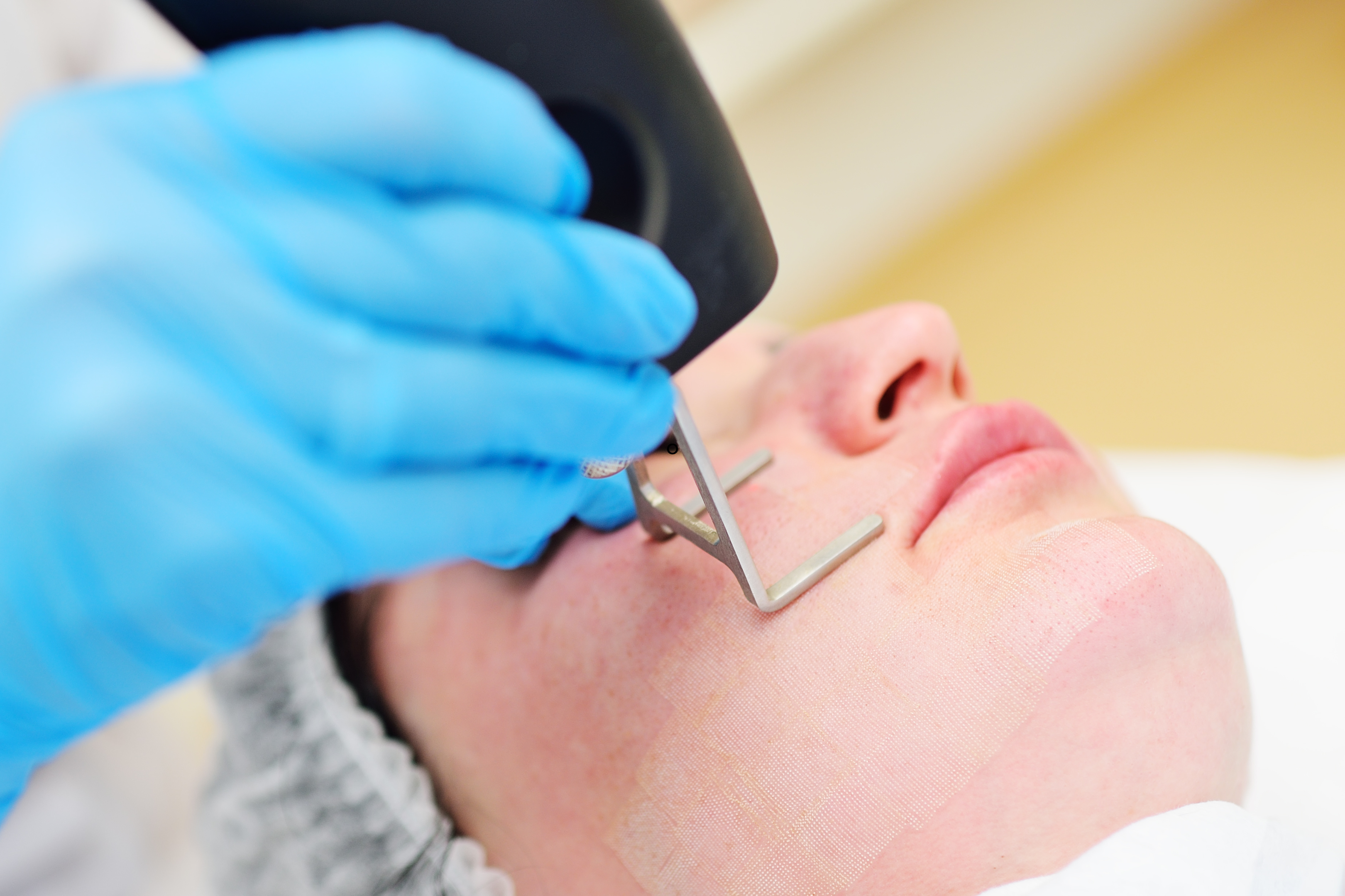 Fractional laser being used on a person's cheek