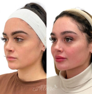 Before and after jawline contouring on an Allure Aesthetics client.