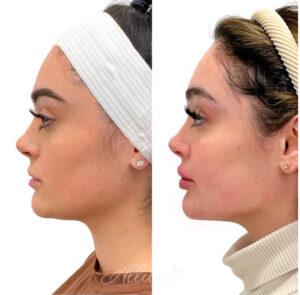 Before and after jawline contouring of an Allure Aesthetics client 