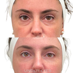 Before and After Undereye Filler for Hollowing by Allure Aesthetics