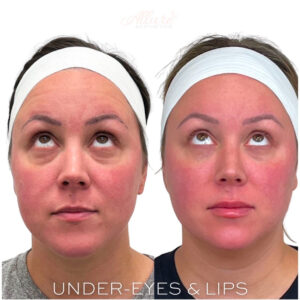 A before-and-after photo of an Allure Aesthetics client showcasing noticeable improvements in under-eye bags, hollowness, and darkness, along with enhanced lip volume.