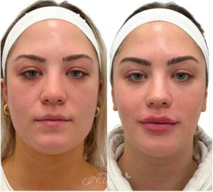 Before and after results of an Allure Aesthetics patient who received masseter injections for facial slimming and lip filler for enhanced volume.