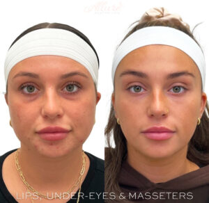 Before and after image of a woman treated with our trademarked Full Face Refresher, featuring dermal fillers under the eyes to fix dark circles under eyes.