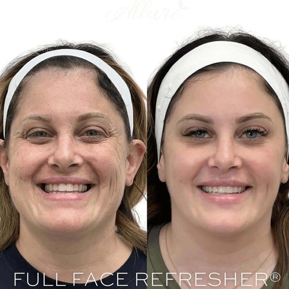 3 sessions of BBL. Client also receives injectable treatments.