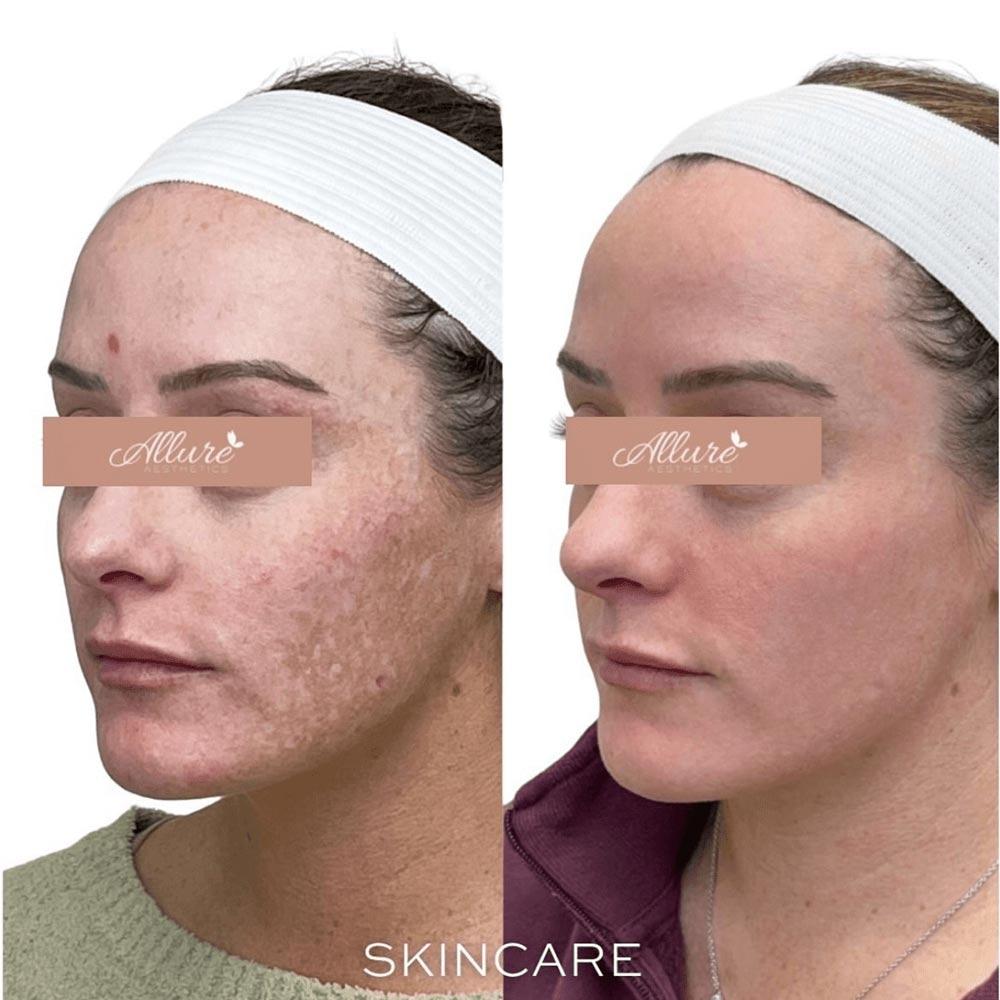Multiple sessions of BBL & Moxi. Client also utilizes a ZO Skin Care regimen and receives injectables treatments.