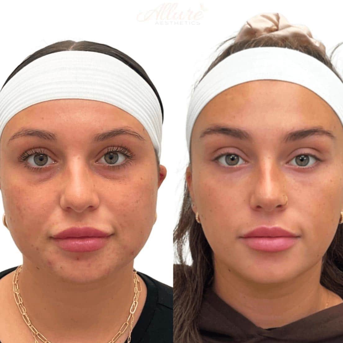 Comprehensive facial transformation following Full Face Refresher® over 2.5 years, including lip correction, facial slimming, and under-eye rejuvenation