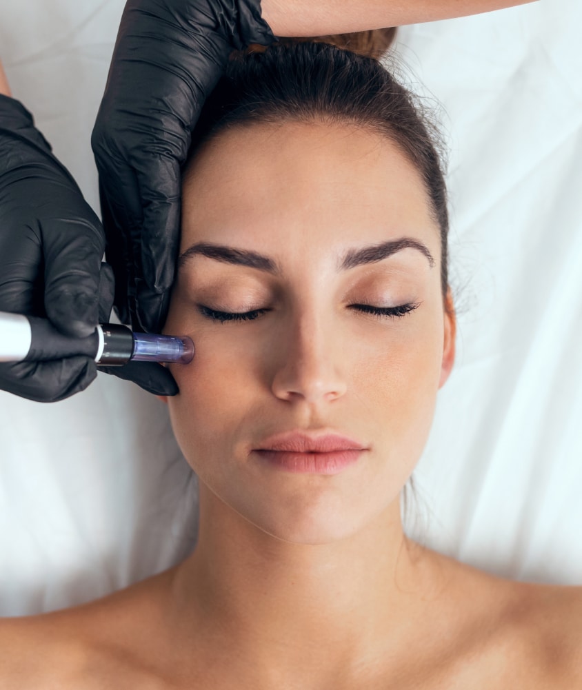 Microneedling treatment for skin texture improvement and collagen induction, available at Allure Aesthetics in King of Prussia