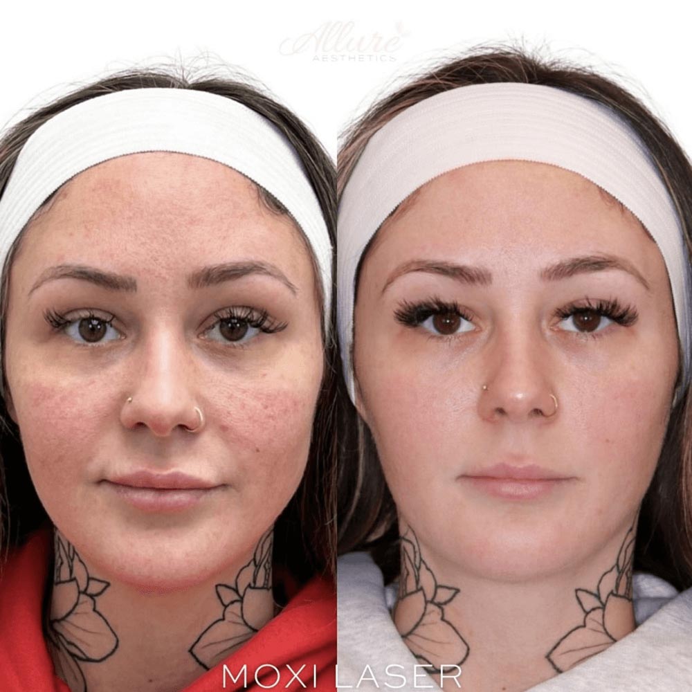 Multiple sessions of Moxi. Client also receives injectable treatments.