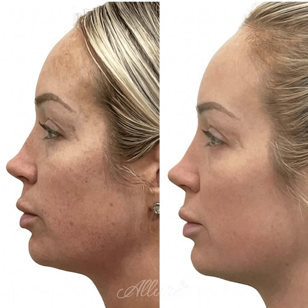 Multiple sessions of Moxi. Client also receives injectable treatments.