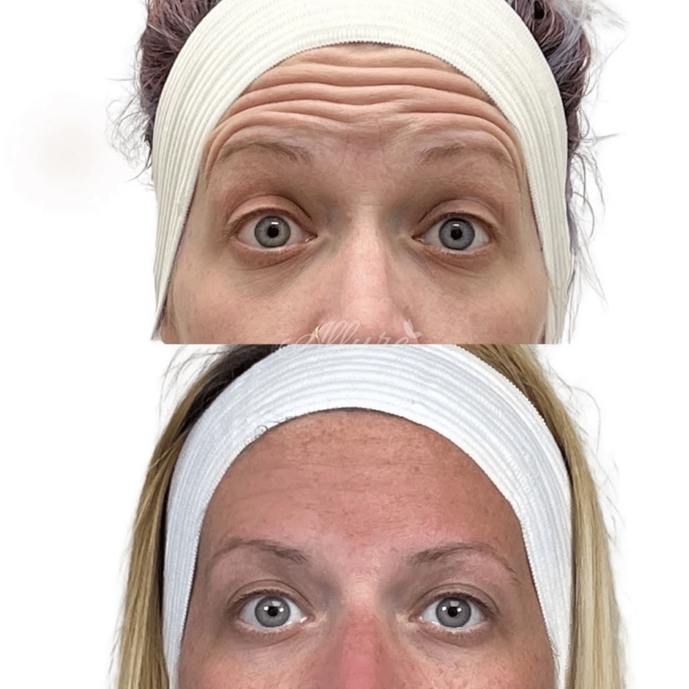 Before and after image of a woman with visible wrinkle reduction in the forehead and eye area following upper face Dysport treatment