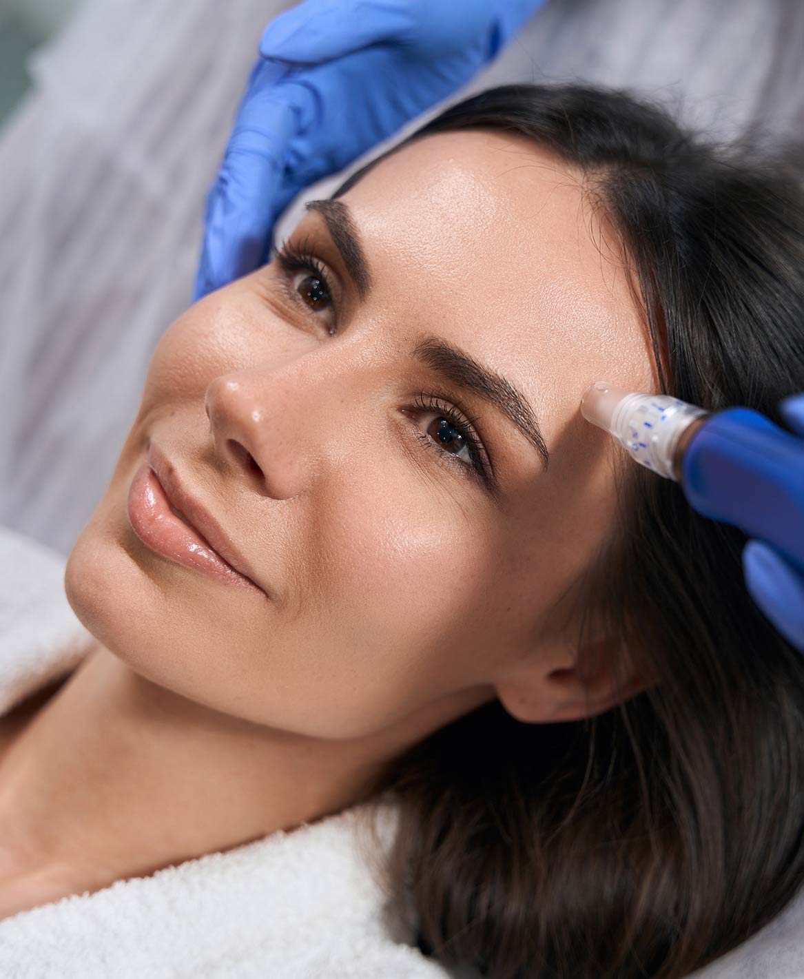 Microneedling device in use during professional skin rejuvenation treatment at Allure Aesthetics in the Main Line area
