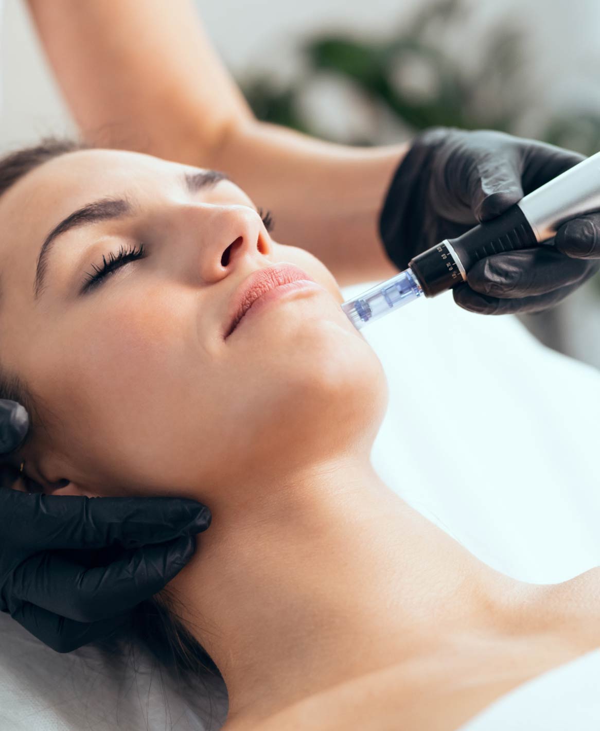 Side profile showing microneedling procedure to reduce acne scarring and discoloration, as offered at Allure Aesthetics