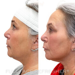 Sculptra vs Radiesse - When used in its original state, Radiesse can add instant structure and volume that Sculptra does not.