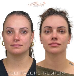 Front-facing before and after full facial balancing showing proportional, natural results