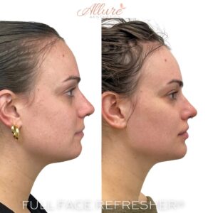 Side profile before and after full facial balancing demonstrating balanced facial structure