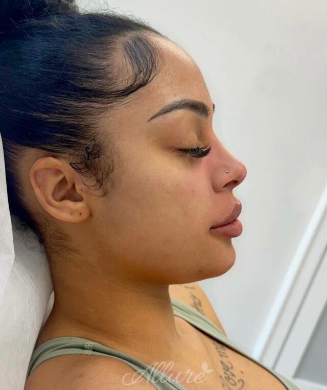Side Profile Goals 😍

With cosmetic injectables, precision is always key 🔑 Our goal here was to improve facial balance ⚖️ and enhance her already beautiful features by lifting and contouring the face where needed. 
 
Her treatment included:
✨Jawline 
✨ Chin
✨ Non surgical Rhinoplasty 
✨ Smile Lines
✨ Lips 
✨ Cheeks
✨ Smile lines

Swipe over to see her before ➡️

#TG #fullfacerefresher #medspa #jawline #sideprofile #goals #beforeandafter #instagood #instalike #instadaily #medicalspa #lipfiller #skincare #nonsurgical #nonsurgicalnosejob #nonsurgicalrhinoplasty #jawline