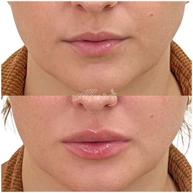 Lips 👄 

For this first time lip filler client we achieved a fuller and more defined lips, helping to create a balanced and harmonious facial appearance. The procedure is carefully tailored to each individual's unique needs and desired outcome, ensuring a natural and subtle result.