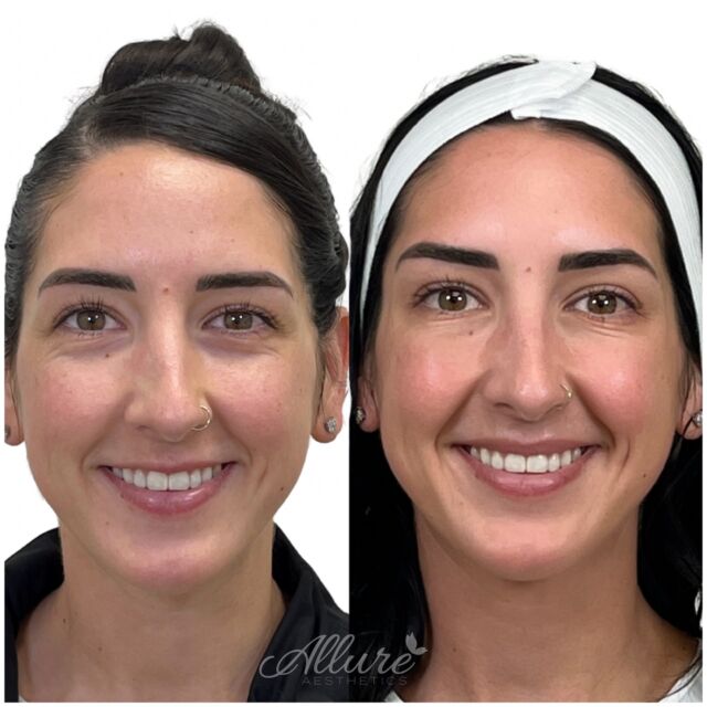 This beauty comes all the way from Maryland 🚗 to keep up with her Dysport💉 

By targeting the muscles responsible for causing wrinkles and creases, Dysport helps smooth out the skin, minimizing the appearance of crow's feet, forehead lines, and frown lines. It effectively relaxes the muscles, preventing them from contracting and creating deep wrinkles.

One of the remarkable aspects of Dysport is its ability to selectively target specific areas, allowing for precise control over the treatment. This means that while it softens unwanted lines and wrinkles, it doesn't completely paralyze the muscles. Instead, it allows for natural facial expressions, ensuring a more subtle and refreshed appearance.

With Dysport, you can confidently express yourself while enjoying a smoother, more youthful look.

#antiwrinkle #dysport #lipflip #botox #beforeandafter #selflove #selfcare #medspa #phillymedspa #selfimprovement #injectables #beauty #instagood #instadaily #injectables #wrinkles #skincare #skin #skingoals