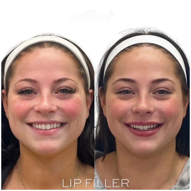 First time lip filler 👄 

For this beauty we used 1️⃣ syringe of filler in her lips + a lip flip with Dysport to help prevent her upper lip from curling under when she smiles 😃 By using dermal fillers, her lips were given a fresh new shape, more volume, and balance, resulting in a plump and stunning look that enhances her natural beauty.

Our approach is to provide a subtle yet impactful enhancement that complements each individual’s features. By carefully sculpting the lips, we can achieve a natural-looking result that enhances their unique beauty.

Please note: swelling and bruising are present.