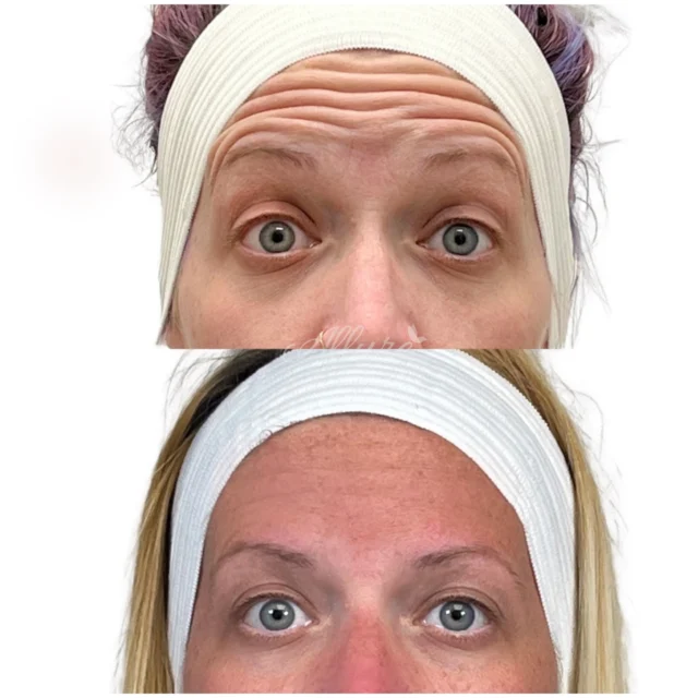 ✨WRINKLE REDUCTION ✨

One of the most common misconceptions we hear about neurotoxin treatments is that they will freeze your face 🥶, but the truth is that your dosage can be adapted to maintain as much facial movement as you desire!

Dysport can be injected 💉 around the forehead and eyes 👁 to reduce the appearance of crow’s feet, frown lines, and forehead lines. Every client requires a different dose, strategically placed depending on individual anatomy. Our goal is to always keep you looking natural and like yourself… but without creating new wrinkles 😉🦋

Clients can expect to see results starting 3️⃣ to 5️⃣ days after their treatment with full results being seen after 3️⃣ weeks!