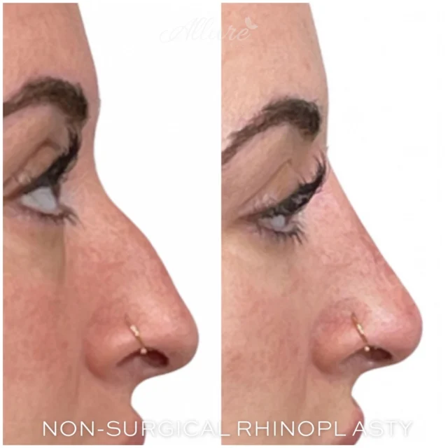 Non Surgical Rhinoplasty ✨

For this client, we disguised the dorsal hump along the bridge of the nose by strategically injecting 1️⃣ syringe of dermal filler over 1️⃣ session. Now the nose 👃 appears smaller, more contoured, and beautifully balanced with her profile, while looking completely natural!

#TR #nose #nonsurgical #liquidnosejob #nonsurgicalrhinoplasty #nosejob #self #selflove #new #beforeandafter #photo #beauty #medspa #medicalspa #dermalfillers #instagood #instalike