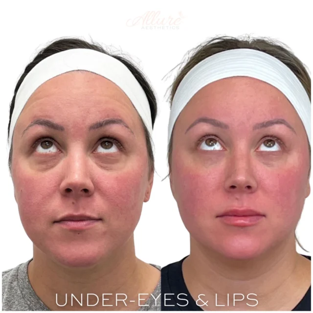 Under-eyes 👀 & Lips 👄 

By strategically injecting 💉 dermal filler into the tear troughs, we were able to reduce the dark circles and the creasing under the eyes, leading to an overall well-rested and more refreshed appearance!

For her lips we used one syringe 💉 We focused on building vertical ↕️ height and volume💧 to her upper lip and contouring her cupid’s bow for more definition and shape.

#teartroughfillers #undereyefiller #undereye #lips #lipfiller #lipaugmentation #lipinjections #darkcircles #darkcirclestreatment #selflove #selfcare