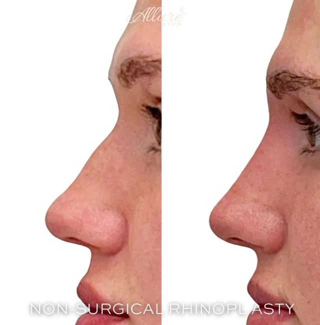 Here is the before & after from our last reveal video 👃 ✨  For this beauty, we disguised the dorsal hump along the bridge of the nose by strategically injecting 1️⃣ syringe of dermal filler over 1️⃣ session. Now the nose 👃 appears smaller, more contoured, and beautifully balanced with her profile while looking completely natural!