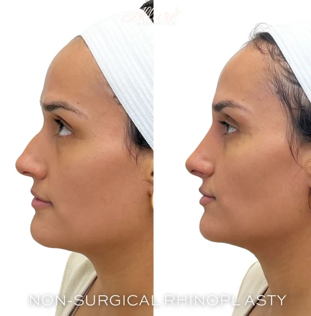 ✨ 𝗡𝗢𝗡-𝗦𝗨𝗥𝗚𝗜𝗖𝗔𝗟 𝗥𝗛𝗜𝗡𝗢𝗣𝗟𝗔𝗦𝗧𝗬 ✨  Our non-surgical rhinoplasty 👃 offers a truly life-changing experience, allowing you to reshape and refine your nose without the need for invasive surgery. 🌟  With the expertise of our skilled providers at Allure, we create stunning, natural results tailored to each individual’s unique features. Whether you're looking to enhance symmetry, reduce bumps, or define the tip, our non-surgical approach can completely revitalize your profile.  #nose #nonsurgical #liquidnosejob #nonsurgicalrhinoplasty #nosejob #self #selflove #new #beforeandafter #photo #beauty #medspa #medicalspa #dermalfillers #instagood #instalike #TG