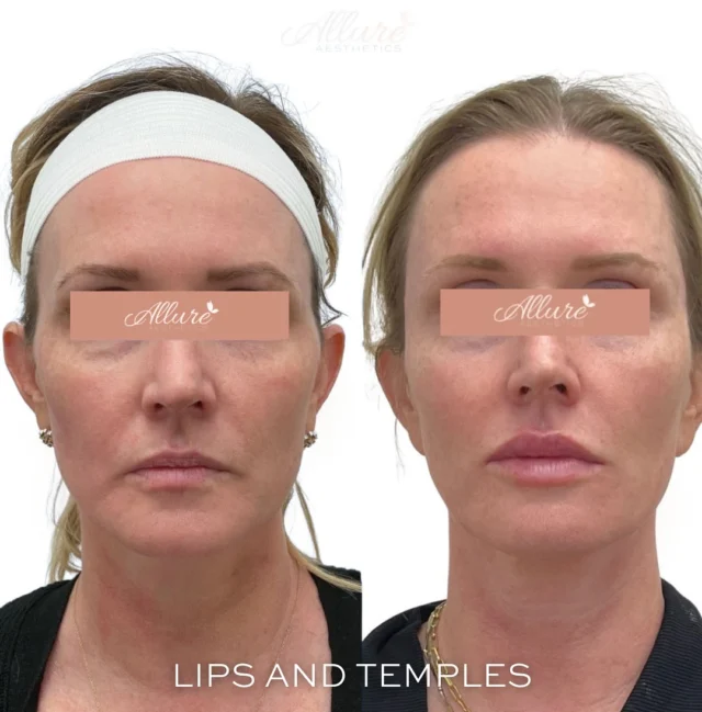 Lips & Temple Filler ✨💉  ✨ Temple filler restore's volume in the temples, creating a beautifully balanced and youthful contour to the face. This treatment smooths out hollows, enhancing facial harmony.  Lip filler was done to add definition and fullness to the lips, giving them a plump, youthful appearance. Together, these treatments work wonders, rejuvenating her entire look 🙌✨  #TG #lipfiller #temples #templefiller #medspa #lips #restore #fullfacerefresher #refresh #antiaging #self #selflove #selfcare #injectables #dysport #antiwrinkle #relivingmyyouth #explorepage