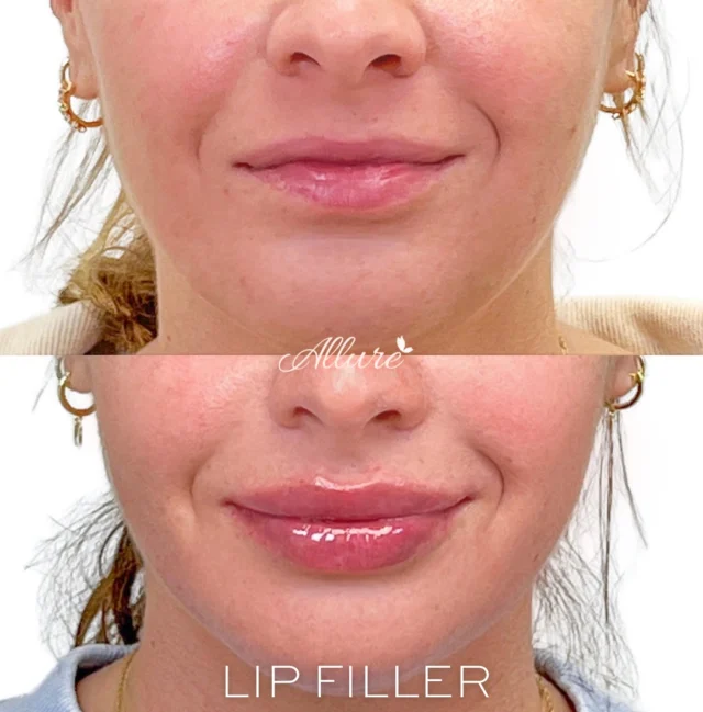 Lips 👄 ✨  The subtle artistry 💉 of lip filler not only adds volume but also enhances the natural contours of her lips, creating a luscious, juicy look that's simply irresistible. 💞  By carefully customizing the amount and technique, we achieved a perfect balance that complements her facial features and boosts her confidence. This transformation is a beautiful reminder of how a little enhancement can make a big difference in elevating your overall appearance. Ready to embrace your best lips? 💋  #TR #allureaesthetics #lips #lipfiller #lipaugmentation #lipinjections #medspa #medicalspa #instalike #injectables #injections #lip #explorepage