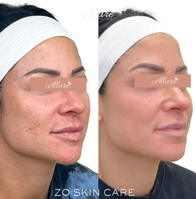 ✨ ZO Skin Care ✨  Unlock the transformative power of ZO Skin Care with a personalized regimen tailored to your unique skin needs. Our team of experts is dedicated to understanding your individual concerns, ensuring that you receive a customized approach that delivers optimal results. With ZO's scientifically-backed formulations, we create a comprehensive skincare routine that not only addresses issues like dryness, aging, and acne but also promotes overall skin health and radiance.  Experience the difference of working with professionals who are passionate about helping you achieve your skincare goals. Trust us to guide you on your journey to luminous, rejuvenated skin—because with ZO Skin Care, you deserve nothing less than the best.  Interested in a ZO Skin care regimen type "" Skin "" Below ⬇️ ✨