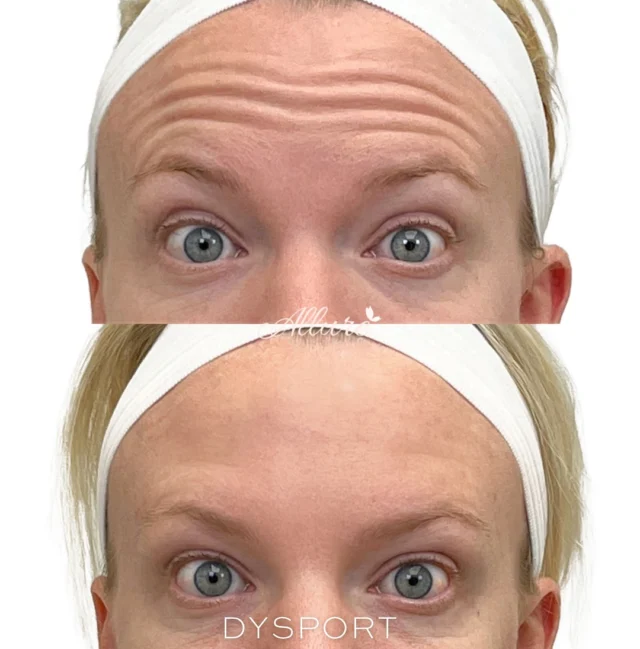 ✨ Dysport 💉  🌟 **1. Forehead Lines:** In the first image, our client showcases her natural expression,  by raising her brows, revealing fine lines that many of us experience with age and facial movements. After her Dysport treatment, the second image highlights a beautifully smooth forehead, free from those unwanted lines.  😊 2. Crow's Feet: Moving on to our client smiling, the second set of images captures the delicate crow's feet around her eyes. The ""before"" photo shows the lines that often accompany joy and laughter, but after Dysport, her smile shines brighter and smoother than ever! Say goodbye to those lines and hello to a more youthful gaze.  🐰 3. Bunny Lines: Lastly, let’s talk about bunny lines! The third image shows our client squinting, revealing those unwanted lines on the sides of her nose known has "" bunny lines "" Post-Dysport treatment, the after photo shows a remarkable improvement, with those lines effectively diminished.  Dysport isn’t just about smoothing out lines; it’s about enhancing your natural beauty and boosting your confidence!  #TR #dysport #botox #antiwrinkle #antiageing #wrinkles #finelinesandwrinkles #medspa #medicalspa #selfcare #skincare #skin #allureaestheticsllc