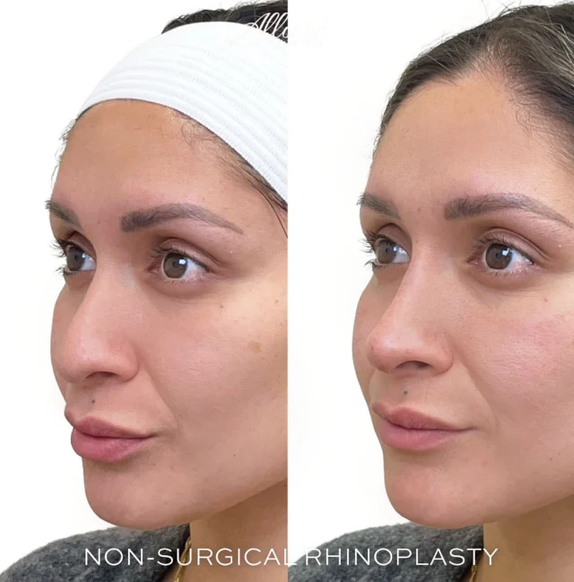 Achieving facial harmony is a delicate art, and with our expertise in non-surgical rhinoplasty, you’re guaranteed the highest level of care. Whether it’s a nose with a downward turn and noticeable hump or one in need of a straightened, lifted profile, non-surgical rhinoplasty offers a modern solution for creating perfect harmony among your features. ✨ 👃  #MedicalSpa #NonSurgicalRhinoplasty #LiquidNoseJob #NoseJob #NoseContouring #AllureAestheticsLLC #Rhinoplasty #AestheticMedicine #BeautyEnhancement #FacialContouring #NoseShaping #AestheticProcedures #Skincare #BeautyGoals #YouthfulAppearance #CosmeticTreatment #MinimallyInvasive #RhinoplastyResults #SelfCare #ConfidenceBoost