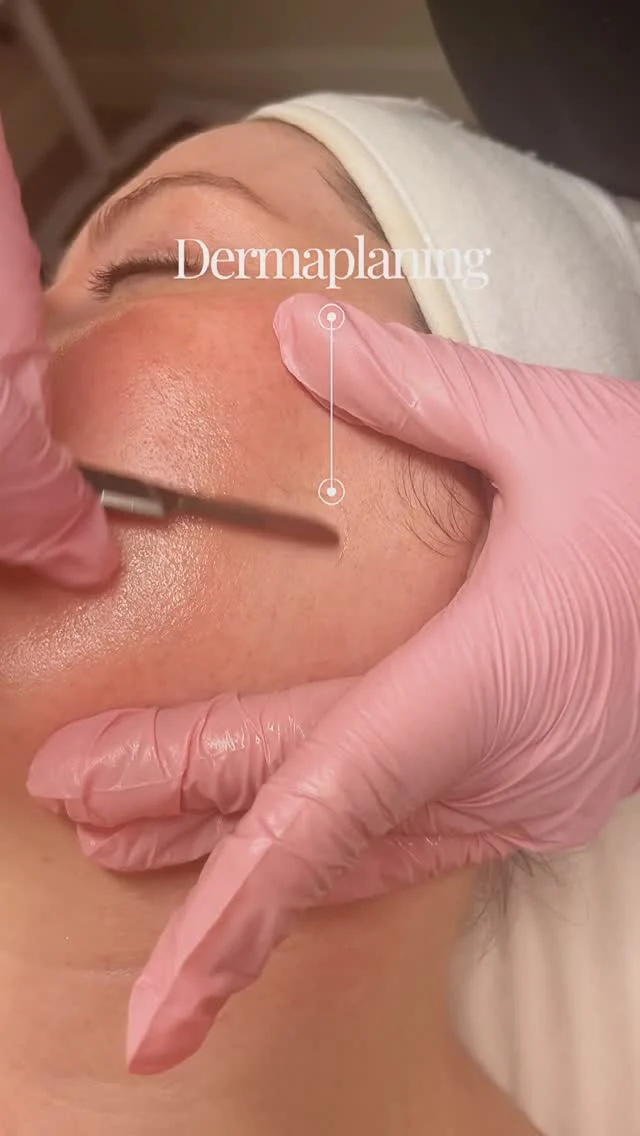 Unlock your skin's true potential with dermaplaning✨  This gentle exfoliation technique removes dead skin cells and fine vellus hair, revealing a smoother, more radiant complexion beneath. Perfect for enhancing the effectiveness of your skincare products and achieving a flawless makeup application. 🙌  #skincare #selfcare #dermaplaning #skincareroutine #glowingskin #skincarecommunity #facial #beauty #skincaretips #exfoliation #healthyglow #skincarelovers #dermatology #radiantskin #selflove #wellness