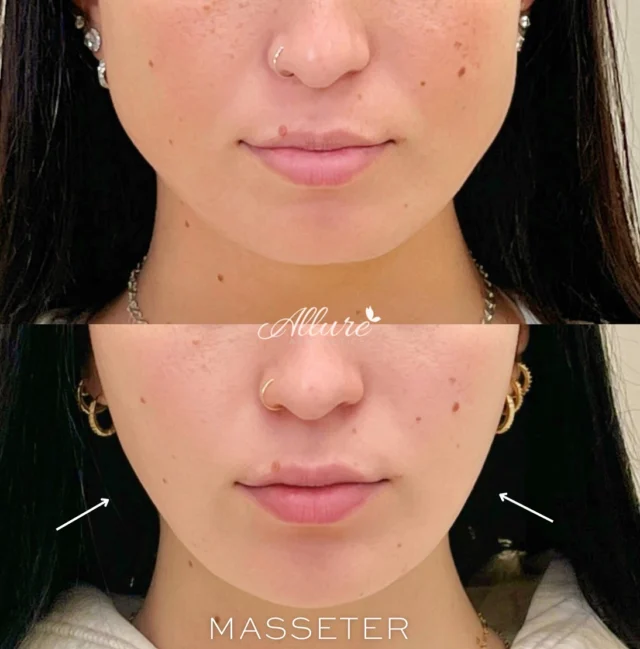 Experience the power of Dysport with our transformative Masseter reduction treatment! ✨  In this before and after, see how our precise injections effectively slim the Masseter muscles, creating a more refined jawline and enhancing facial contours. Our expert approach ensures natural-looking results, helping you achieve the elegant profile you desire. Discover the transformative effects of our treatments at Allure.💞✨  #masseter #masseterbotox #facialslimming #jawline #jawlinecontouring #medspa #phillymedspa #self #injectables #injections #dysport