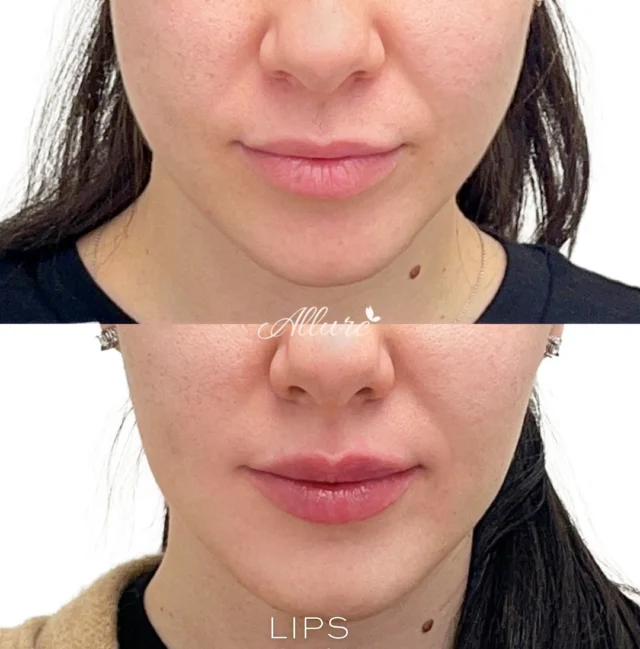 Lips 👄  At Allure, we prioritize enhancing natural beauty through expert lip filler techniques. In this transformation, we focused on achieving symmetrical hydration, all-around volume, and well-defined contours, including the creation of a beautiful Cupid's bow. Our goal is to provide results that not only enhance but also maintain a natural look. Experience the art of lip enhancement with us. ✨🙌