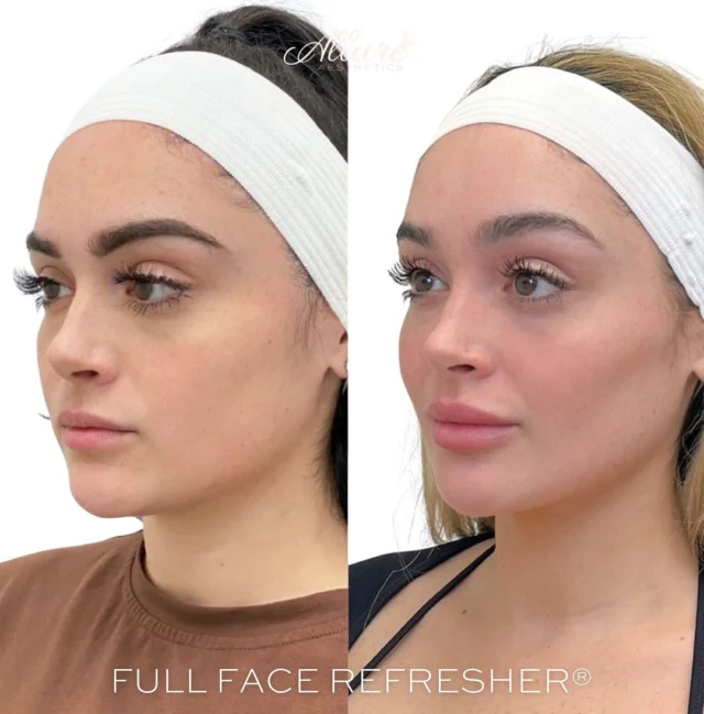 ✨Full Face Refresher ® ✨  This beauty has been diligently maintaining her injectables since 2020! 🙌  For her Lips: 👄 We added volume, height, and definition to beautifully accentuate her natural features.  For her Jawline and Chin: We crafted a more structured jawline and defined chin, enhancing the lower half of her face for a strikingly elegant profile.  For her Cheeks: We enhanced her cheeks by adding filler to restore volume, creating a lifted and contoured effect that radiates youthfulness.  These procedures are meticulously customized to align with your specific aesthetic goals, ensuring minimal downtime and immediate, stunning results!  #allureaestheticsllc #fullfacerefresher #jawline #chin #jawlinecontouring #nurseinjector #TR #self #selfimprovement #antiaging #dysport #skincare #skinhealth #lips