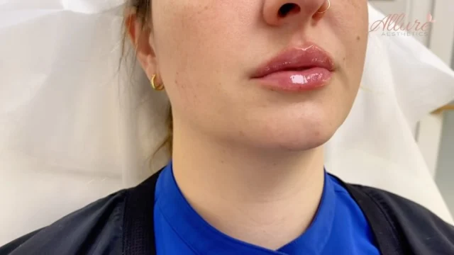 Plump & perfect lips 💋✨  Our lips are the finishing touch to any look, effortlessly enhancing your natural beauty. Choosing the right aesthetic injector who understands your goals and the art of anatomy makes all the difference! Embrace your pout and let it speak volumes.