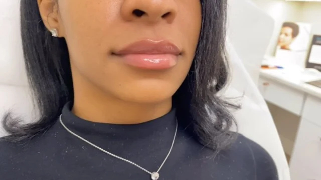 Freshly filled and flawlessly shaped ✨ 👄 

These lips are plump, smooth, and beautifully balanced immediately after her filler appointment. Whether you’re looking for a subtle enhancement or a fuller pout, our expert injectors tailor every treatment to your unique features and goals.

Your dream lips? We’re just one appointment away.

#LipFiller #FillerQueen #LipGoals #AestheticInjector #LipFillerResults #DermalFiller #PlumpLips #BeautifulLips #AestheticMedicine  #Juvederm #LipInspo #LipEnhancement #TR