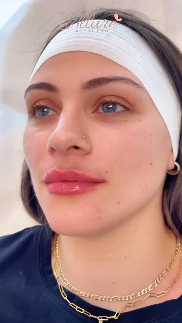 You saw this beauty’s reveal in our last video—now here’s the full before & after 👄 We enhanced her natural lips by adding volume, defining her Cupid’s bow, and giving her the perfect amount of height. ✨💞