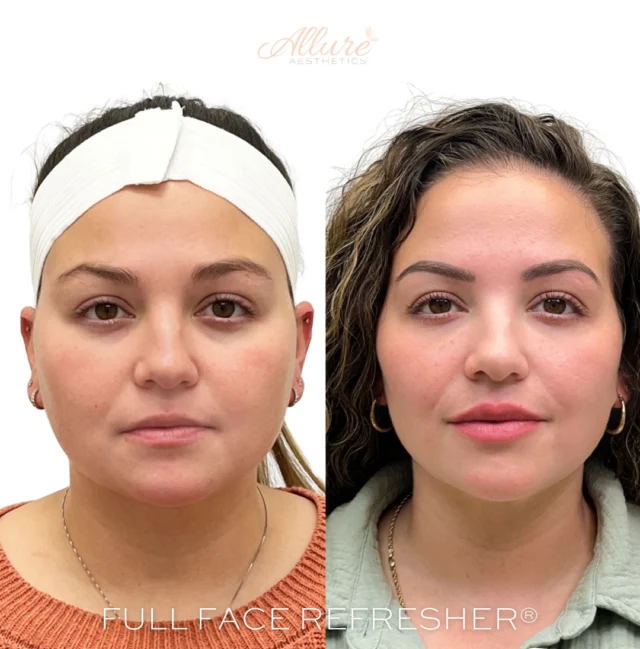 Our Signature Full Face Refresher ®
This before & after speaks for itself — balanced, refreshed, and beautifully enhanced.

Designed to restore harmony and rejuvenation, this customized treatment brings out your best features while maintaining a natural look.

Can you guess what was done in this transformation?
Comment your guesses below — we love hearing what stands out to you! 💞✨

Click the link in our bio to book now 
————————————————————
👩🏼‍⚕️Tanya Atiyeh Gallagher CRNP, AGPCNP-BC
👩🏼‍⚕️Taylor Romeo CRNP, AGPCNP-BC
👩🏼‍⚕️Cynthia Steckler, RN BSN
👩🏻‍⚕️Kelly Morell CRNP, FNP-BC
👩🏼‍⚕️Melissa Graber RN, BSN, LE

#FullFaceRefresher #FacialBalancing #NonSurgicalEnhancement #MedicalSpaResults #AestheticMedicine #FacialRejuvenation #NaturalLookingResults #BeforeAndAfter #BeautyBoost #GlowUpJourney #SkinGoals #AestheticClinic #FaceContouring #AntiAgingTreatment #MedSpaGlow #InjectablesBeforeAndAfter #FacialHarmonization #SkincareThatWorks #EnhanceYourBeauty #SubtleResultsBigImpact