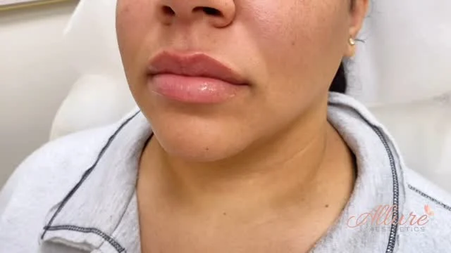 Every lip is unique — and that’s exactly how we approach each treatment. 💉✨ Whether you’re looking for subtle volume or full definition, our customized lip filler technique enhances your natural shape. Freshly injected and already flawless. 👄