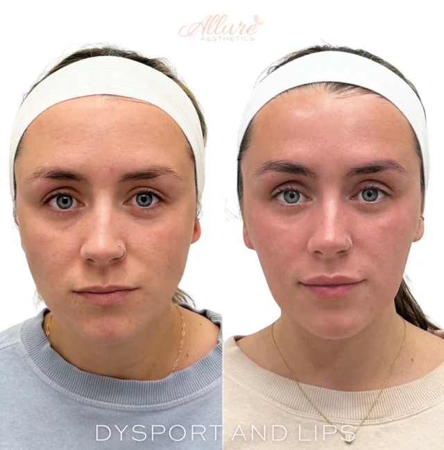 Dysport & Lip Filler ✨

For this beauty we did Dysport in her masseter muscles, which helps relax the jaw and slim the lower face for a softer, more contoured appearance. This is a great treatment for anyone dealing with jaw tension or grinding — and it also creates a more sculpted jawline.

We also treated her upper face, targeting the area around the eyes and bunny lines (those fine lines that appear on the sides of the nose). This smooths expression lines and gives a refreshed, more awake look.

To enhance her smile, we did a lip flip, which gently relaxes the muscles around the upper lip, allowing it to roll slightly outward — giving the appearance of a fuller top lip without adding volume.

And of course, we added subtle, natural lip filler for a beautifully enhanced pout — more definition, symmetry, and hydration while still looking like her.

Click the link in our bio to book now 
————————————————————
👩🏼‍⚕️Tanya Atiyeh Gallagher CRNP, AGPCNP-BC
👩🏼‍⚕️Taylor Romeo CRNP, AGPCNP-BC
👩🏼‍⚕️Cynthia Steckler, RN BSN
👩🏻‍⚕️Kelly Morell CRNP, FNP-BC
👩🏼‍⚕️Melissa Graber RN, BSN, LE

#medspa #skincare #botox #beauty #aesthetics #antiaging #lipfiller #medicalspa #fillers #microneedling #skin #filler #juvederm #facial #injectables #laserhairremoval #spa #facials  #selfcare #lips #dysport #beforeandafter #dermalfillers #laser  #skincareroutine